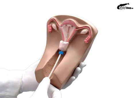 U xơ tử cung có đặt vòng được không? Ưu nhược điểm của phương pháp này