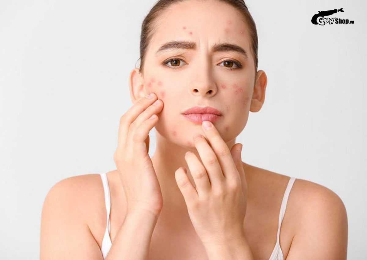 Sau khi nặn mụn không nên ăn gì?