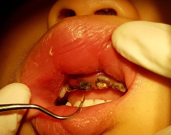 Lơ là chuyện răng miệng, cha mẹ vô tình đẩy con vào nhiều hiểm họa khôn lường