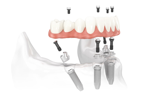Giải đáp thắc mắc: Trồng răng Implant có thực sự an toàn không?