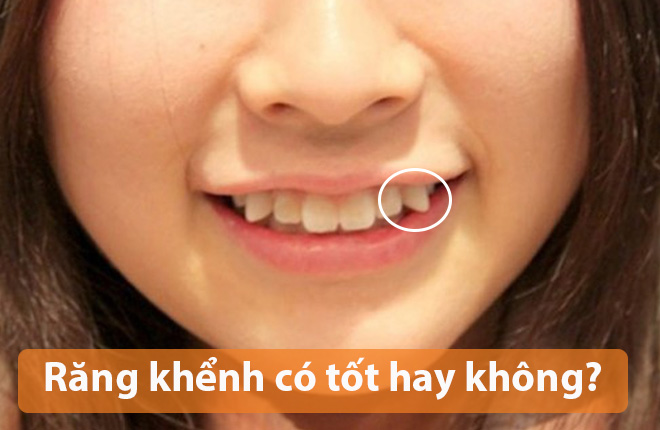 Giải đáp thắc mắc: Có nên niềng răng khểnh không?