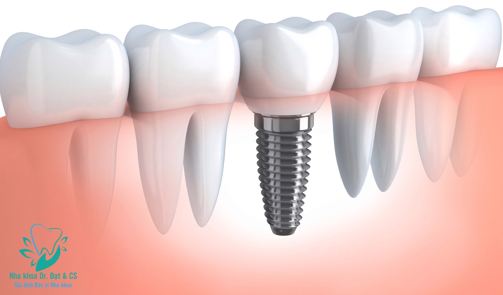 Nên cấy ghép Implant ở đâu?