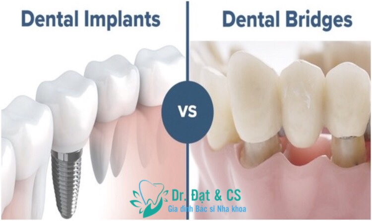 So Sánh Cầu Răng Sứ và Chân Răng Nhân Tạo Implant ???
