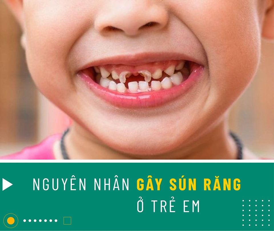 Ðừng để sâu răng gây hậu quả đáng tiếc cho trẻ - Bệnh sâu răng ở trẻ em!