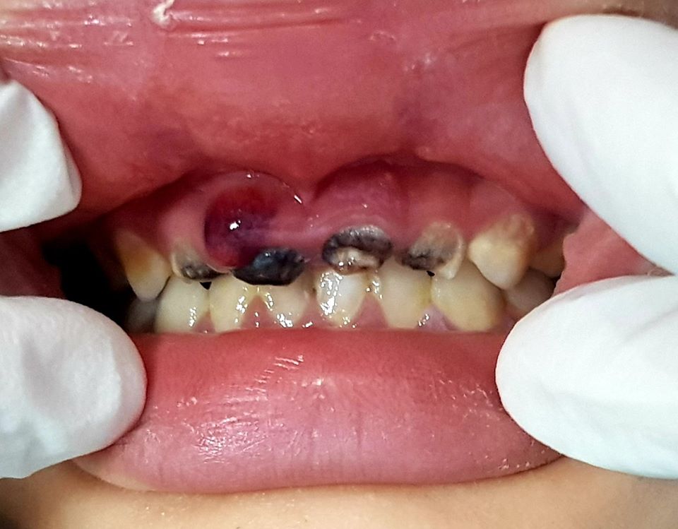 Ðừng để sâu răng gây hậu quả đáng tiếc cho trẻ - Bệnh sâu răng ở trẻ em!