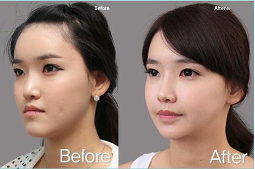 Niềng răng trong suốt có hiệu quả không
