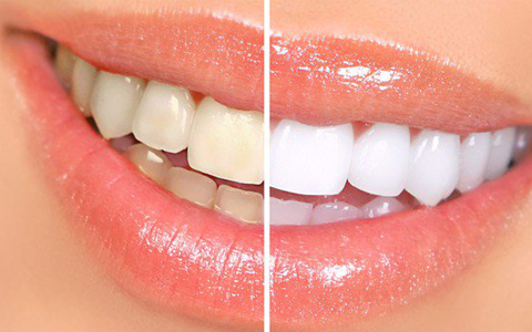 Mặt dán sứ Veneer
