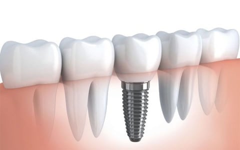 Cấy ghép Implant