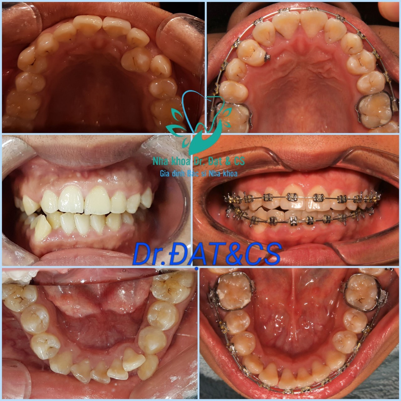 Niềng răng thẩm mỹ và những lời khuyên nếu bạn có ý định niềng răng