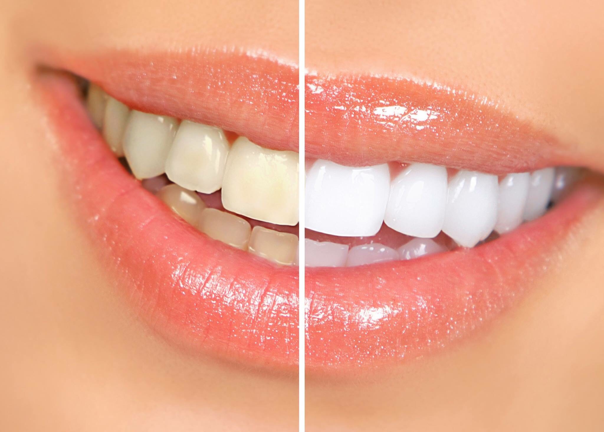 Những điều cần lưu ý khi tẩy trăng răng