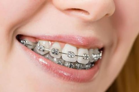 Chỉnh nha là gì? Tại sao? Khi nào?