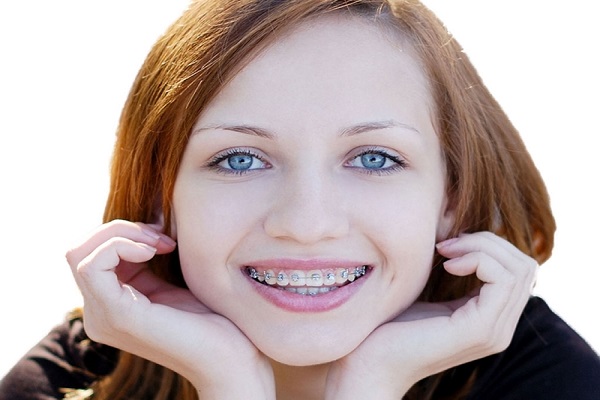 Các hình thức niềng răng thẩm mỹ đang hot nhất hiện nay