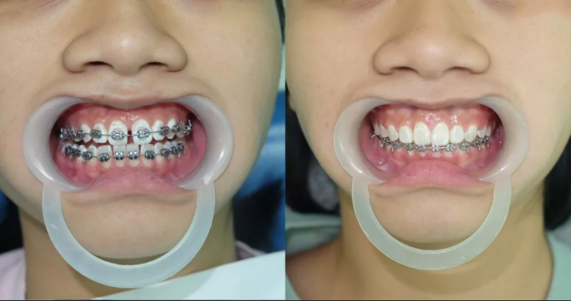 Niềng răng có cần nhổ răng không