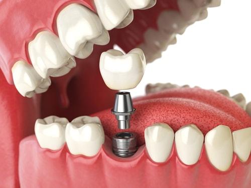 Trồng răng Implant là gì