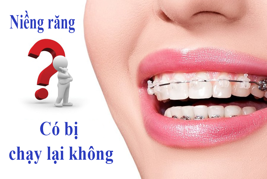 Niềng răng xong có bị chạy lại không