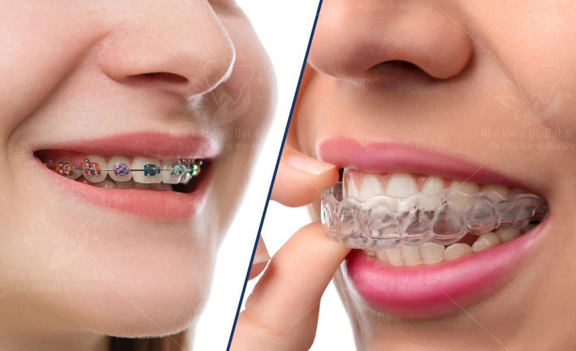 Vì sao Niềng răng không mắc cài đắt mà vẫn được nhiều người lựa chọn?