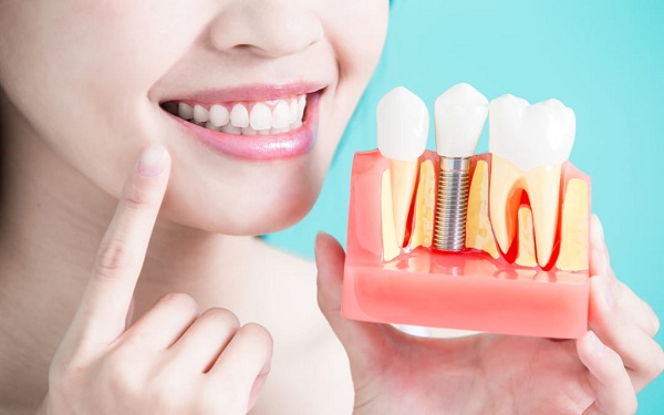 Trồng răng Implant ở đâu tốt - Địa chỉ cấy ghép Implant uy tín