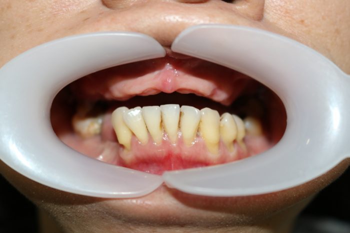 MẤT RĂNG TOÀN HÀM - CẤY GHÉP BAO NHIÊU TRỤ IMPLANT?