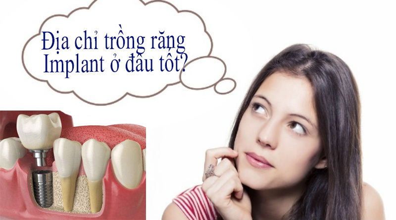Trồng răng Implant ở đâu tốt