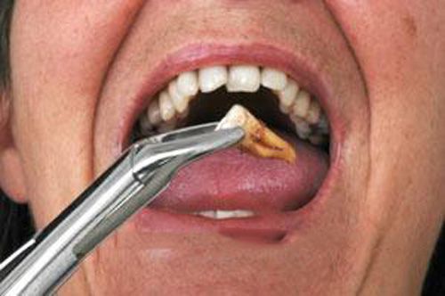 Những điều cần lưu ý sau khi nhổ răng?