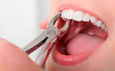 Có nên nhổ răng khôn hay không?