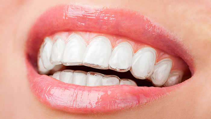 Ưu điểm của Niềng răng trong suốt