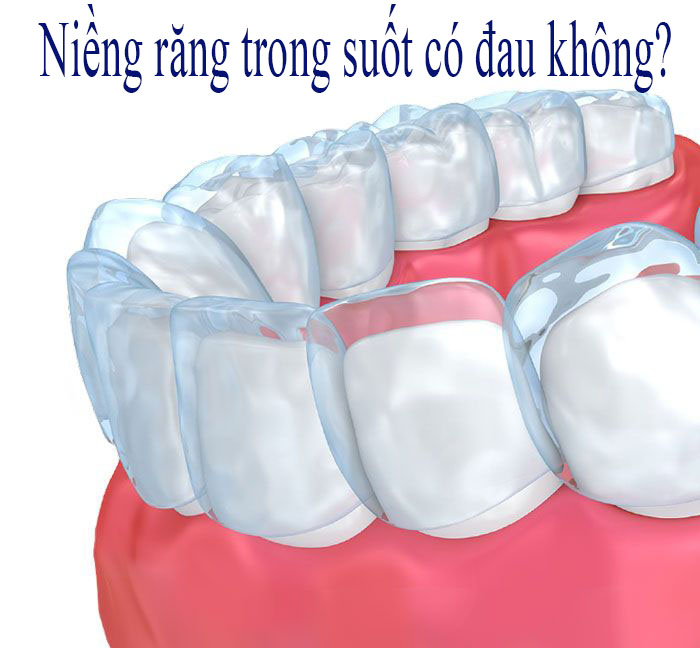 Niềng răng trong suốt có đau không?