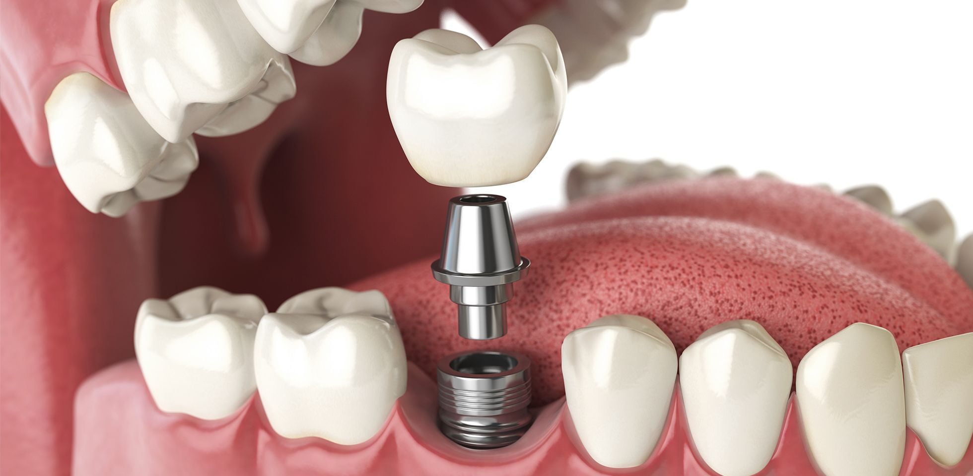 Những câu hỏi thường gặp sau khi cấy ghép Implant