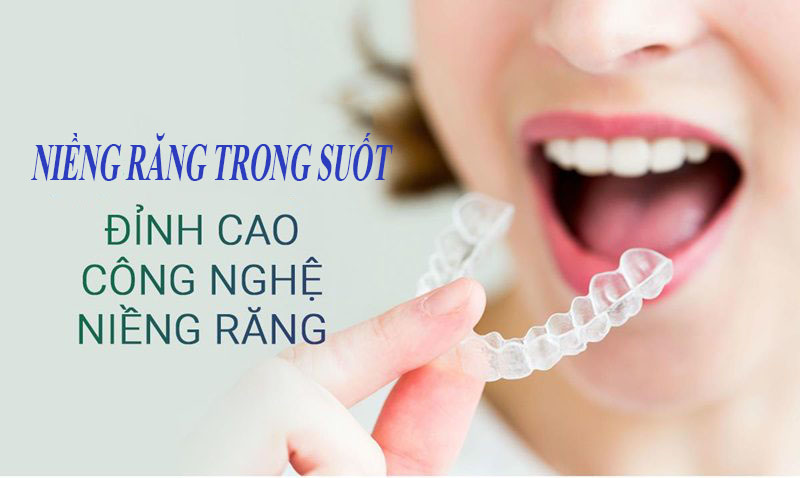 Niềng răng trong suốt là gì