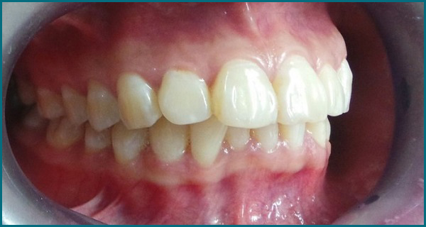 Phương pháp điều trị răng hô (vẩu) hiệu quả và an toàn