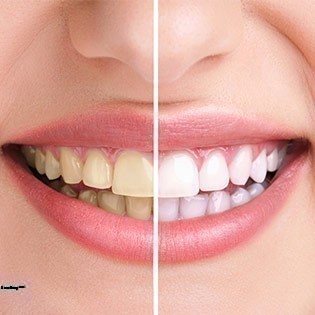 Cao răng và những điều cần lưu ý