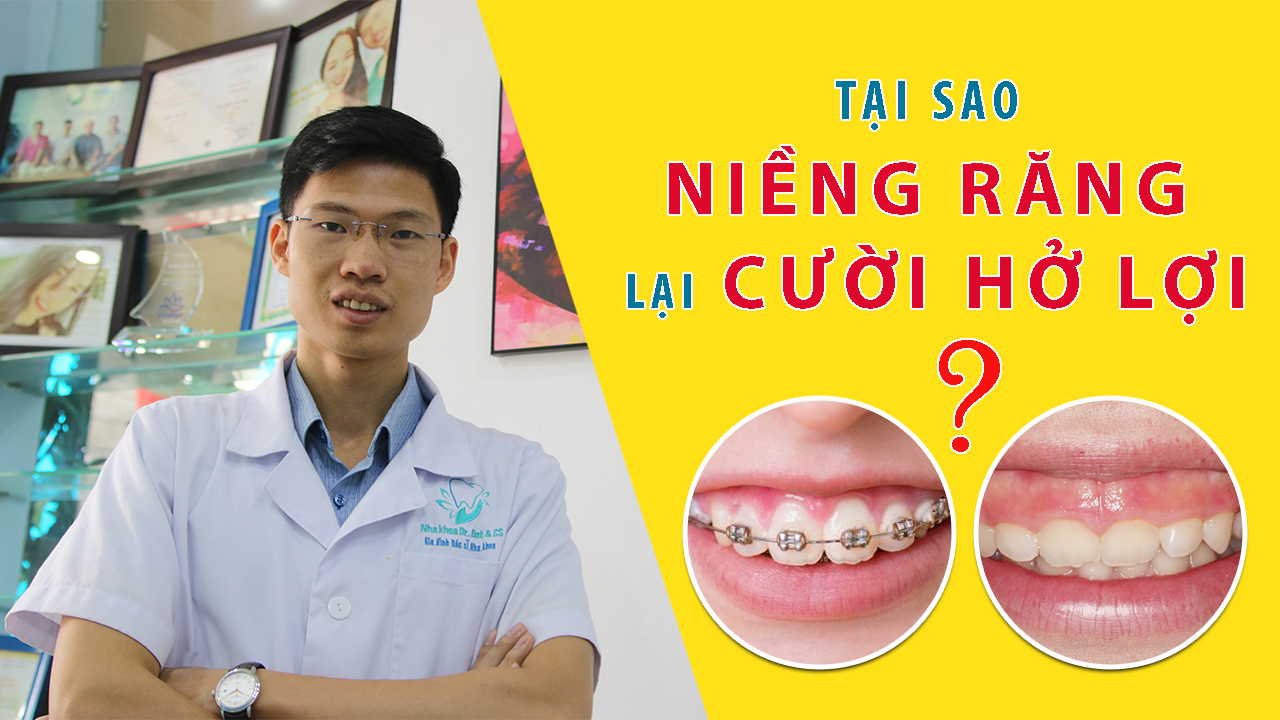Hở lợi sau khi niềng răng? Nguyên nhân do đâu?