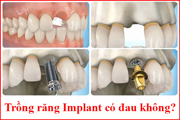 Trồng răng Implant có đau không