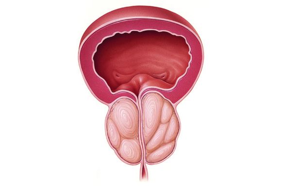 Bệnh tăng sinh lành tính tuyến tiền liệt –