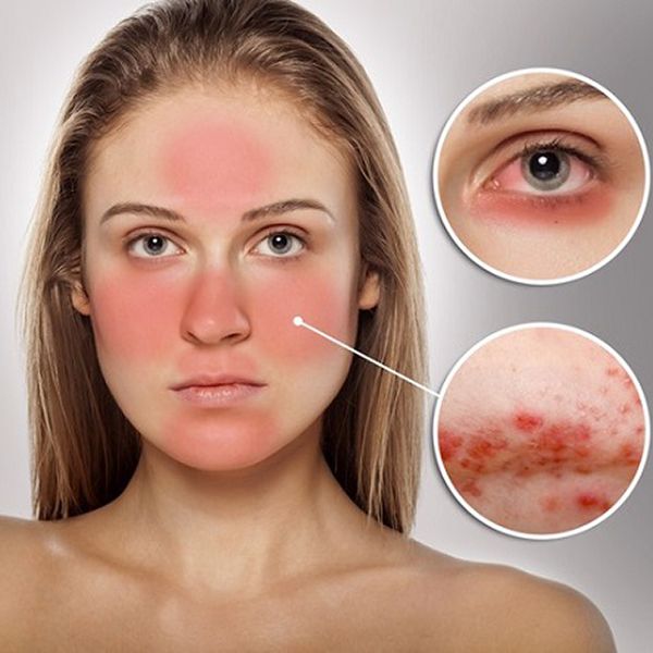 (Phần 1) Cùng tìm hiểu về da nhạy cảm và cách chăm sóc hiệu quả nhất