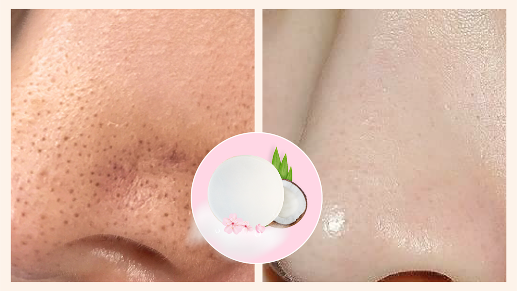 Nguyên Nhân Gây Mụn Đầu Đen Và Giải Pháp Làm Sạch Mụn Đầu Đen Hiệu Quả