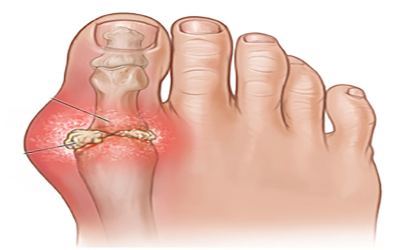 BÍ QUYẾT TRỊ DỨT ĐIỂM BỆNH GOUT CÙNG NƯỚC ĐIỆN GIẢI KANGEN