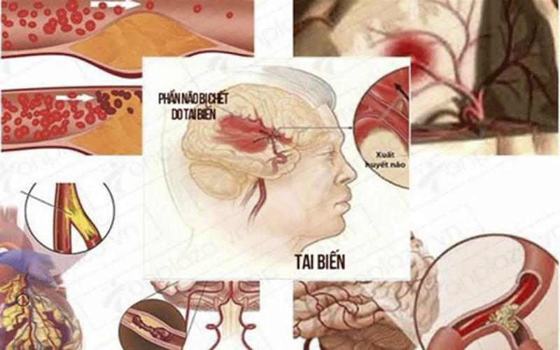 PHƯƠNG PHÁP NGĂN NGỪA VÀ XỬ LÝ TAI BIẾN HIỆU QUẢ TỪ ĐẬU TƯƠNG