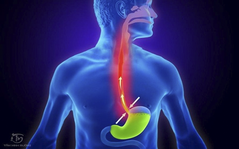 NƯỚC ĐIỆN GIẢI ION KIỀM HỖ TRỢ ĐIỀU TRỊ BỆNH TRÀO NGƯỢC AXIT