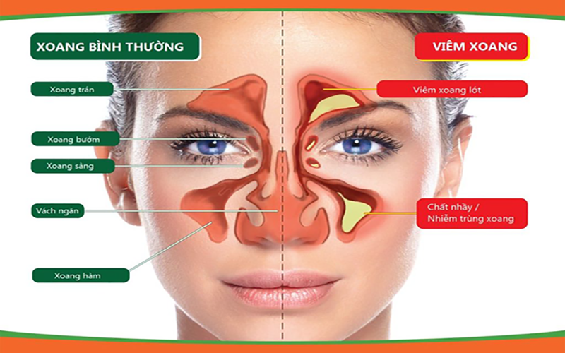 MÁCH NHỎ BẠN CÁCH ĐIỀU TRỊ BỆNH VIÊM XOANG BẰNG NƯỚC KANGEN