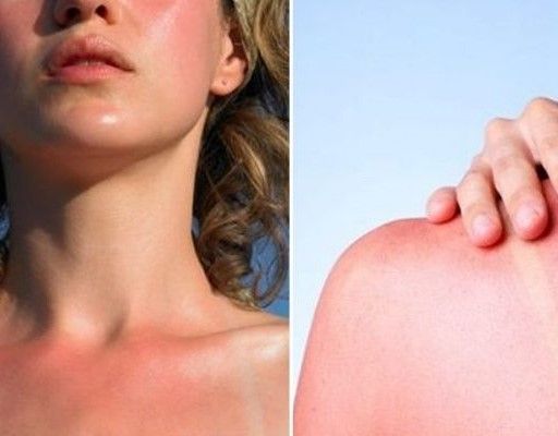 Vô tư tỏa sáng với trọn bộ bí kíp phục hồi làn da cháy nắng