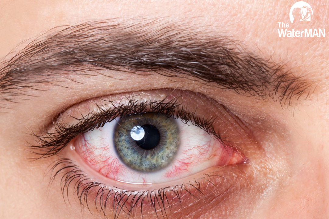 Đau mắt đỏ thường gặp khi thời tiết thay đổi