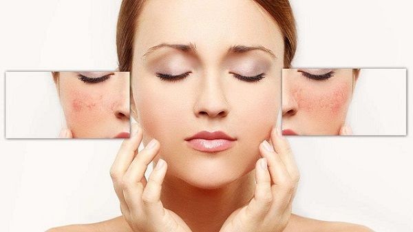 BỘ TRỊ NÁM DA TÀN NHANG HANAYUKI AN TOÀN HIỆU QUẢ