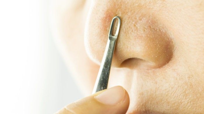 NHIỀU CÔ NÀNG THƯỜNG NHẪM LẪN MỤN ĐẦU ĐEN VỚI THỨ NÀY MÀ KHÔNG BIẾT MÌNH ĐÃ BỊ LỪA SUỐT BAO NĂM NAY