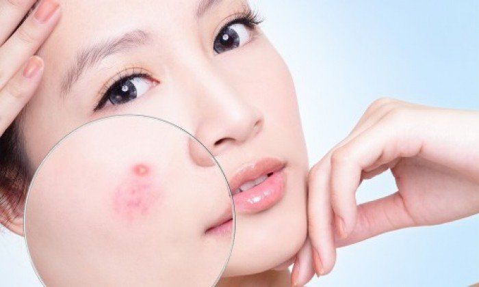 TRUY TÌM NHỮNG THÓI XẤU KHIẾN DA BỊ NỔI MỤN ẦM ẦM