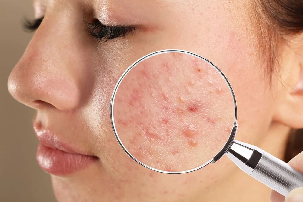 Những nguyên nhân gây ra mụn