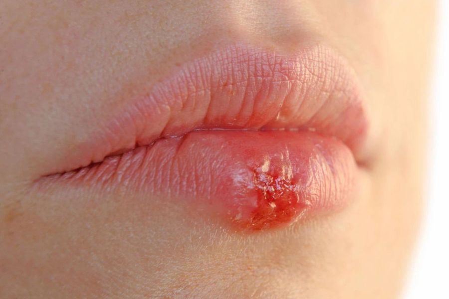 Những nguyên nhân dẫn đến tình trạng dị ứng son môi