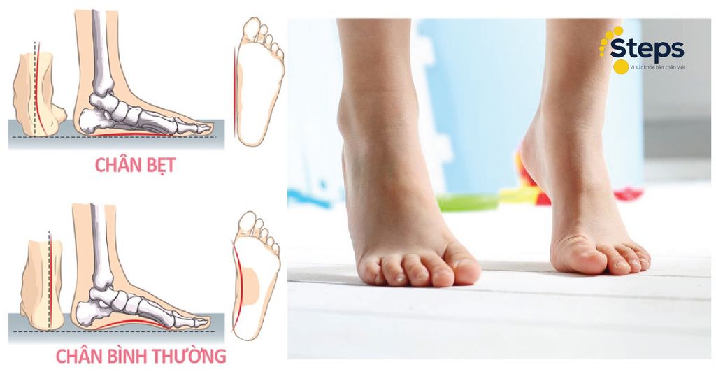 Hướng dẫn cách nhận biết bàn chân bẹt ở người lớn