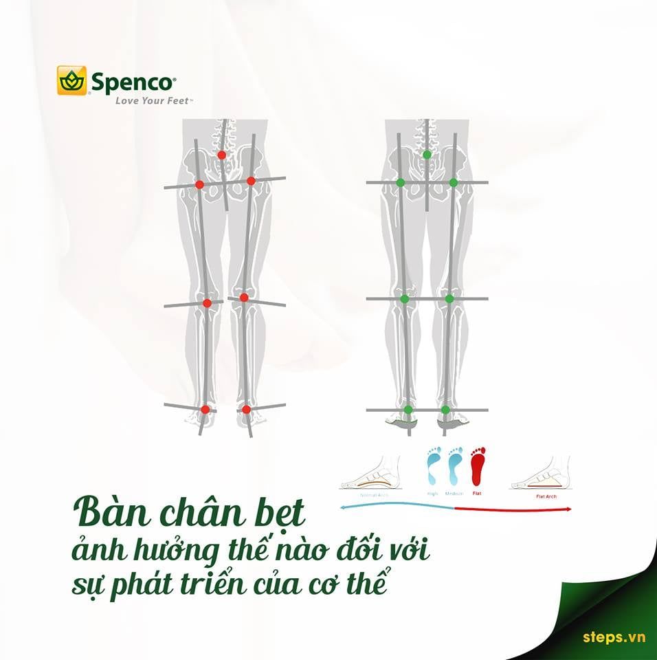 Lót giày và giày dép y khoa - Bảo bối cho bàn chân bẹt