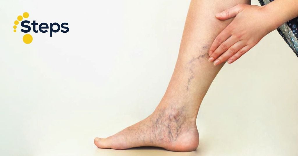 Suy giãn tĩnh mạch và các biện pháp khắc phục